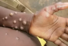 Monkeypox Virus Symptom : स्मॉलपाक्स से ज्यादा खतरनाक होता है मंकीपॉक्स? जानें लक्षण और बचाव what is monkeypox in hindi