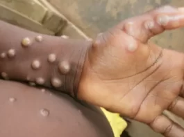 Monkeypox Virus Symptom : स्मॉलपाक्स से ज्यादा खतरनाक होता है मंकीपॉक्स? जानें लक्षण और बचाव what is monkeypox in hindi