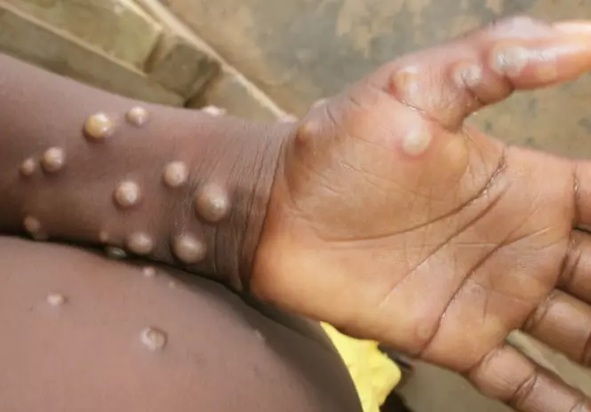 what is monkeypox in hindi